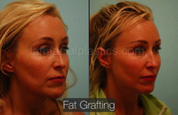 Fat Grafting Before & After