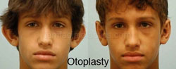 Otoplasty Surgery Results Dallas Texas