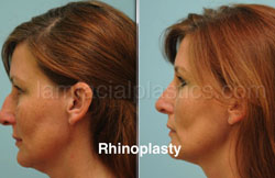 Rhinoplasty Before and After Plano, TX