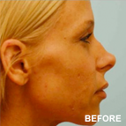 Image of a Rhinoplasty-Nose Job patient