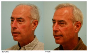 hair restoration before & after
