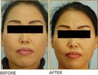 Asian Jaw Reduction Before and After Plano Tx