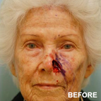Image of a Reconstructive Plastic Surgery patient