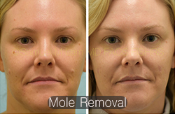 Mole Removal Before & After